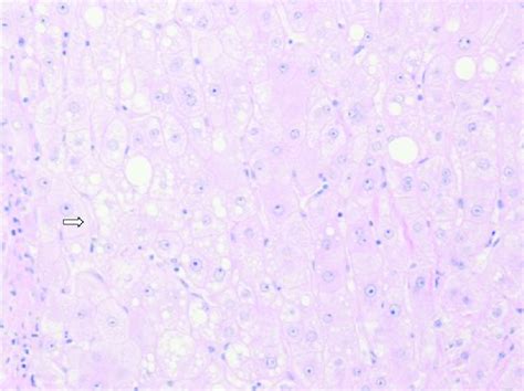 Well Differentiated Hcc With Micro Steatosis Arrow H And E X100 Download Scientific Diagram