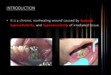 Osteomyelitis Of Jaws