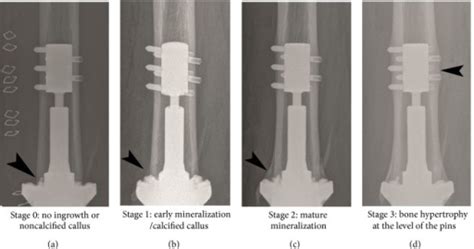 Radiographic Stages Of Osseointegration According To Th Open I