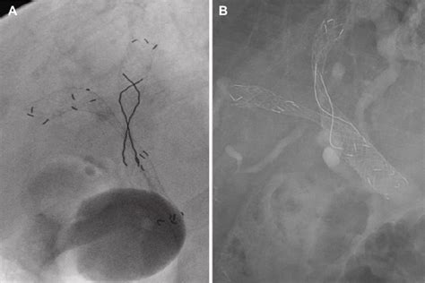 A Stent By Stent Deployment Of Metallic Stents Bonastent Standard