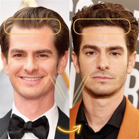 Andrew Garfield Hair Transplant Before And After Transformation