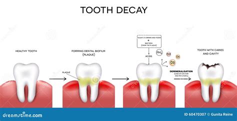 Tooth caries and cavity stock vector. Image of graphic - 60470307