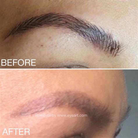 Eyebrow Tattoo Removal Remove Botched Eyebrow Tattoo Immediately