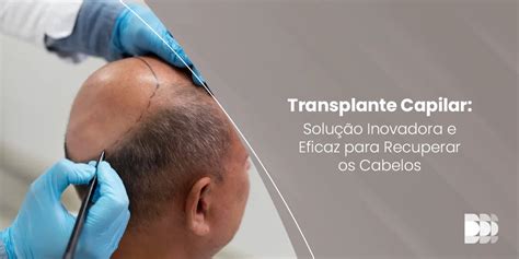 Transplante Capilar Solu O Inovadora E Eficaz Para Recuperar Os Cabelos