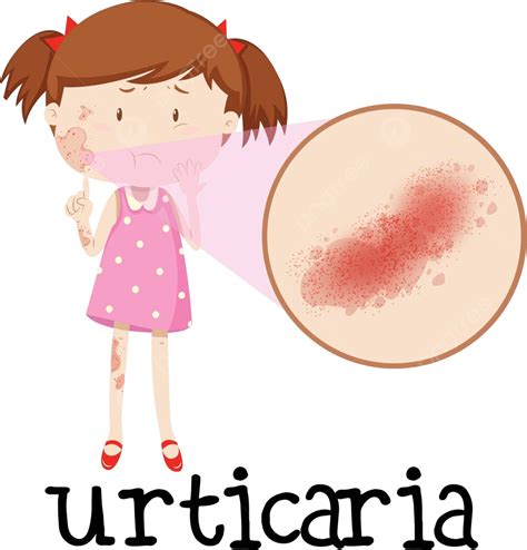 Niña Con Urticaria Fondo Rojo Inflamado Vector Png Antecedentes Rojo Inflamado Png Y Vector