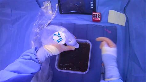 Giving Lidocaine For A Paracentesis Gauge Needle With Ultrasound