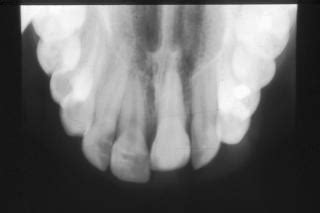 Tooth Ankylosis; Ankylosis, Dentoalveolar; Ankylosis, Tooth ...