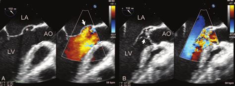 Two Dimensional Color Doppler Transesophageal Echocardiography Showing