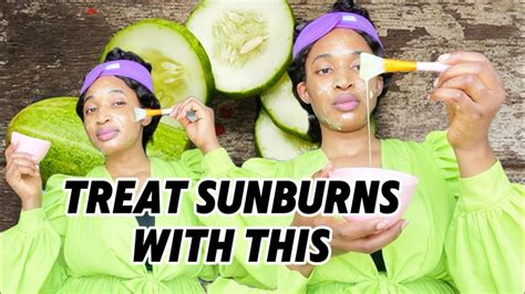 How To Treat Sunburns Immediately Youtube