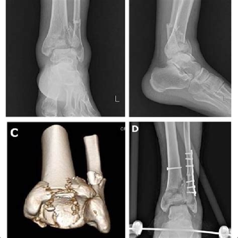 Anteroposterior Mortise And Lateral Radiograph Of A Trimalleolar