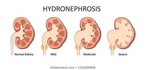 I Am Diagnosed With Hydronephrosis Daily Trust