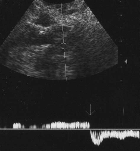 Diagnosis Of Pelvic Congestion Syndrome Using Transabdominal And Transvaginal Sonography Ajr