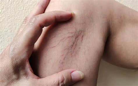 Understanding The Risks Of Untreated Varicose And Spider Veins