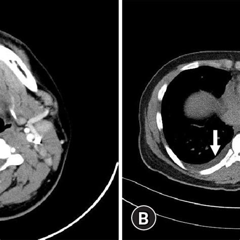 Histological Findings Of The Cervical Lymph Node The Biopsy Specimen Download Scientific