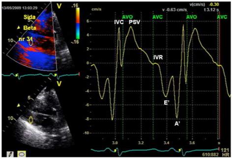 Tissue Velocities Radial Axis This Representative Example Shows The