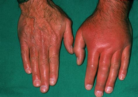 The Hand Of A Patient Affected By Gout Photograph By Dr P Marazzi