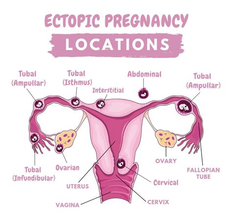 Ectopic Gestation Pregnency Lancet Laparoscopy Center