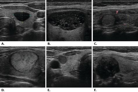 Thyroid Cancer Diagnosis Treatment And Follow Up Intechopen