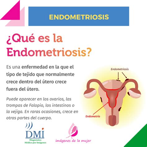 ¿qué Es La Endometriosis — Dmi Diagnóstico Médico Por Imágenes