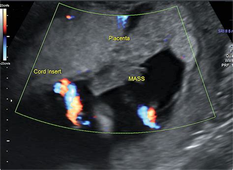 A Bump Inside The Bump A Case Report Of A Chorionic Bump Fang 2019 Sonography Wiley