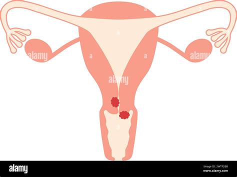 Diagrammatic Illustration Of Cervical Cancer Anatomy Of The Uterus And