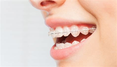 Misaligned Jaw Ismile Orthodontics Melbourne Vic