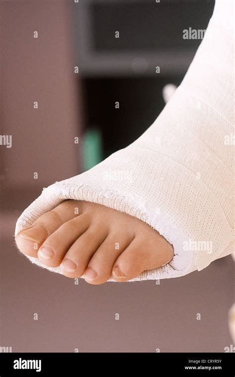 Plaster Leg Cast Legs Stock Photos & Plaster Leg Cast Legs Stock Images - Alamy