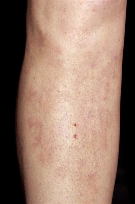 Erythema Nodosum