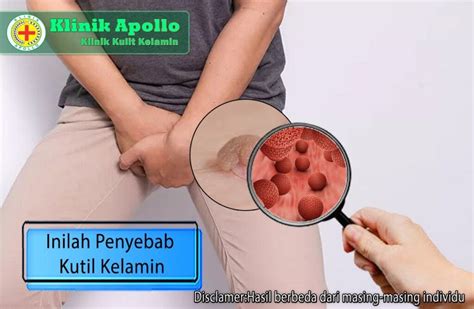 Mengungkap Faktor Pemicu Dan Penyebab Adanya Kutil Di Kelamin