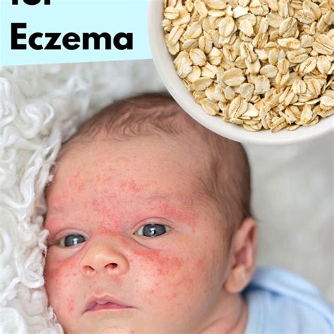 Oatmeal For Eczema A Simple Natural Remedy Beauty Crafter