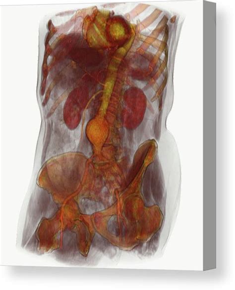 Ct Scan Image Showing An Abdominal Aortic Aneurysm Canvas Print Canvas Art By Callista Images