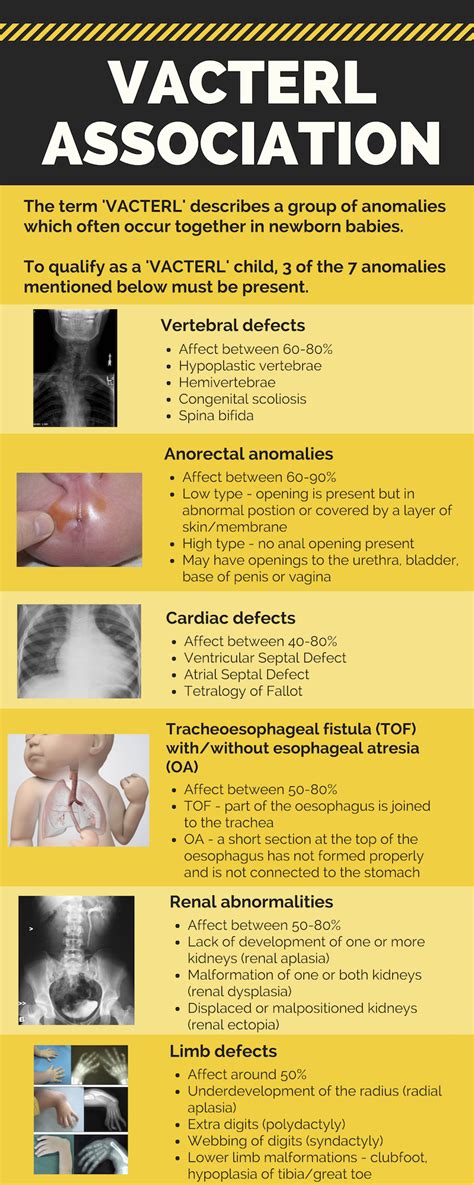 VACTERL association - PEM Infographics