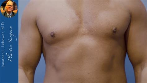 Revision Gynecomastia Gland Removal For A Superior Shape By Dr