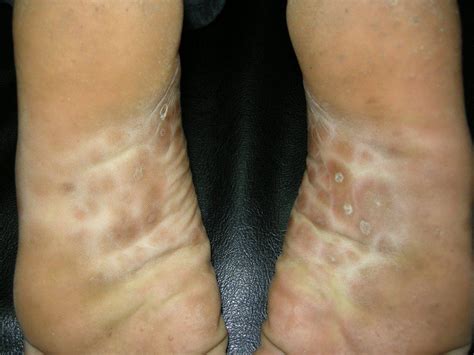 Blue Waffle Disease In Men