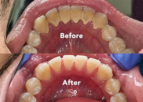 Deep Cleaning Teeth Cost How Much Preparation Is Required Off