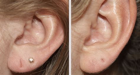 Otoplasty Earlobe Repair