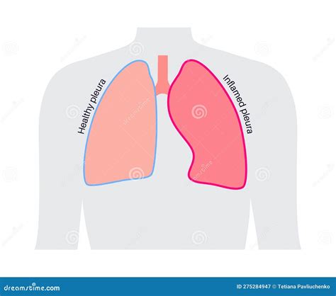 Pleurisy Inflammation Diseases Stock Vector - Illustration of inflammation, trachea: 275284947