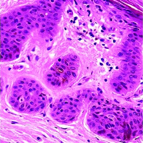 Infiltrating Islands Of Basaloid Cells With Hyperchromatic Nuclei