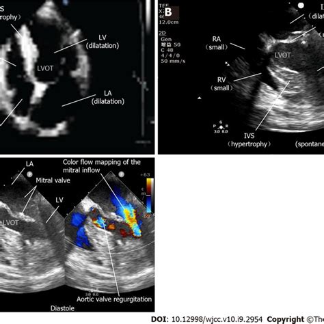 Perioperative Echocardiography A Preoperative Transthoracic