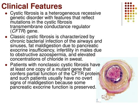 Ppt Cystic Fibrosis Powerpoint Presentation Free Download Id3198238