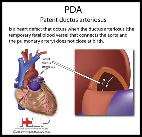 Pda Patent Ductus Arteriosus Pediatric Nursing Nursing Mnemonics