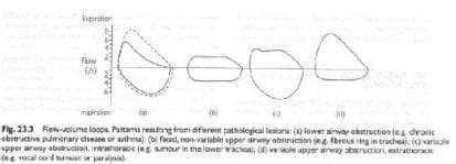 Upper Airway Obstruction Flow Volume Loop