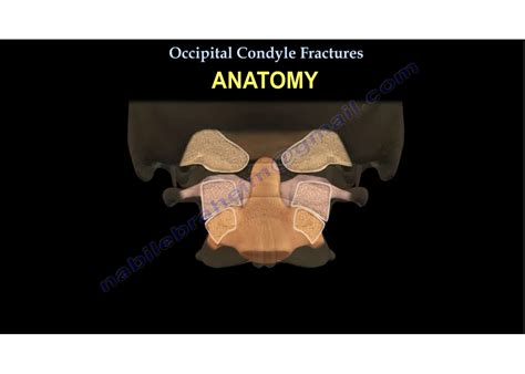 Occipital Condyle Fractures — OrthopaedicPrinciples.com