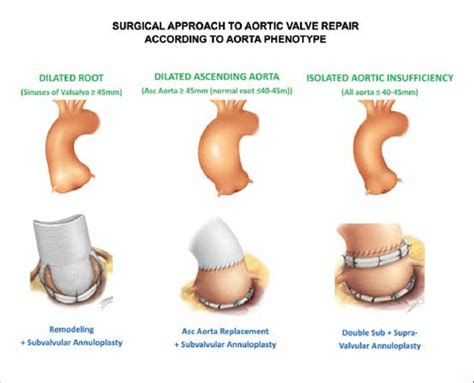 Surgical Approach To The Management Of Aortic Insufficiency According