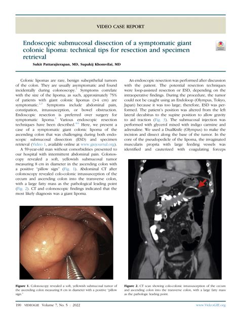 Pdf Endoscopic Submucosal Dissection Of A Symptomatic Giant Colonic