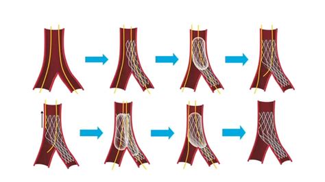 Case Based Step By Step Culotte Technique In A Bifurcation Round