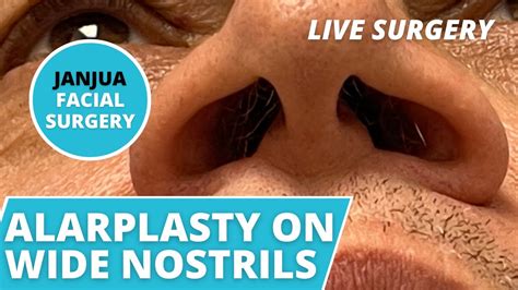 Alarplasty Nostril Narrowing Live Surgery Dr Tanveer Janjua New