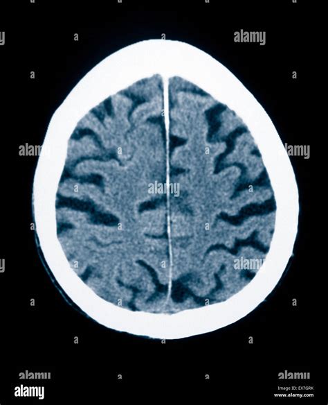 Ct Scan Of An 84 Year Old Man With Alzheimers Disease Ct Shows Brain