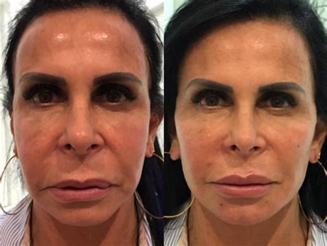 Harmonização Facial Preço E Fotos Do Antes E Depois Toda Atual