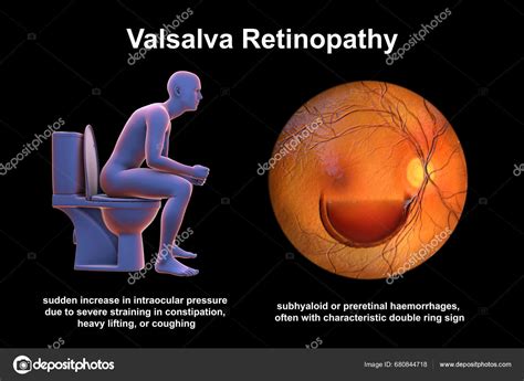 Retinopatía Valsava Una Hemorragia Preetinal Causada Por Aumento